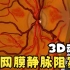 【中英双字】【视网膜静脉阻塞：3D动画】CRVO（central retinal vein occlusion）