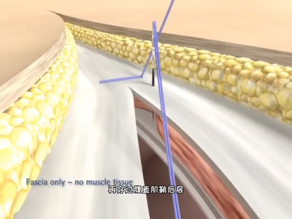 外科大夫真像裁缝，看看腹部手术切口缝合过程，3D演示。。