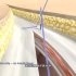 外科大夫真像裁缝，看看腹部手术切口缝合过程，3D演示。。