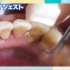 日本人第一次洗牙，牙结石真不少，超解压