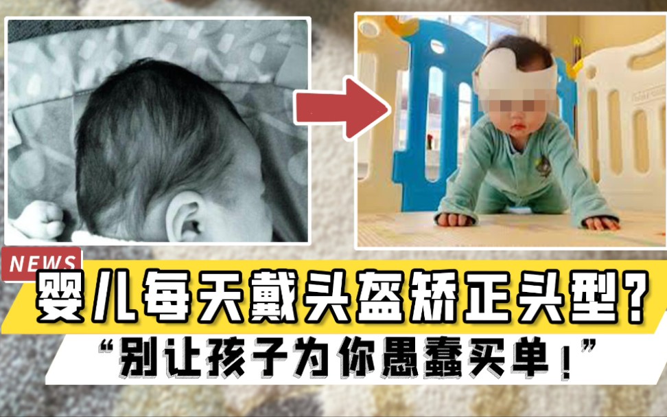婴儿头型矫正，每天戴23小时头盔？儿保专家：别让孩子为你愚蠢买单