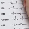 手绘13种异常心电图