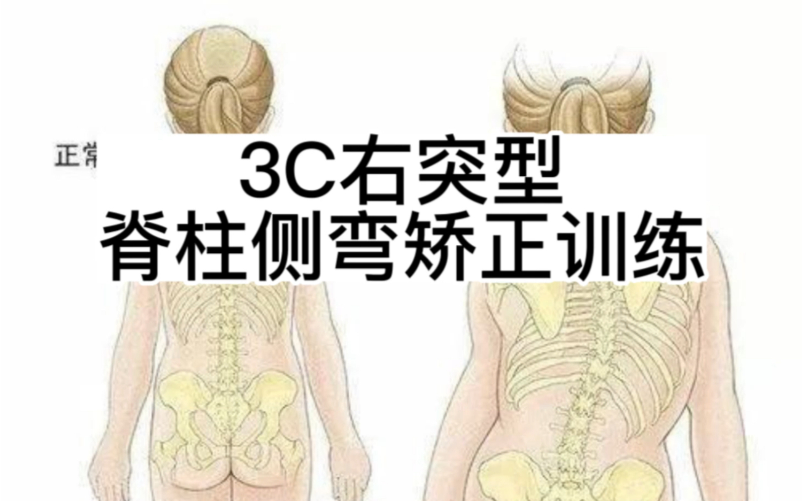 3C型右突型脊柱侧弯矫正训练