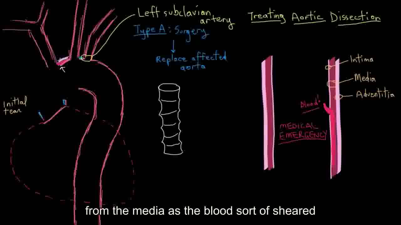 【搬运KhanAcademy】循环系统疾病——Aortic dissection treatment哔哩哔哩 (゜゜)つロ 干杯~bilibili