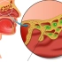 鼻窦炎治疗手术—3D动画