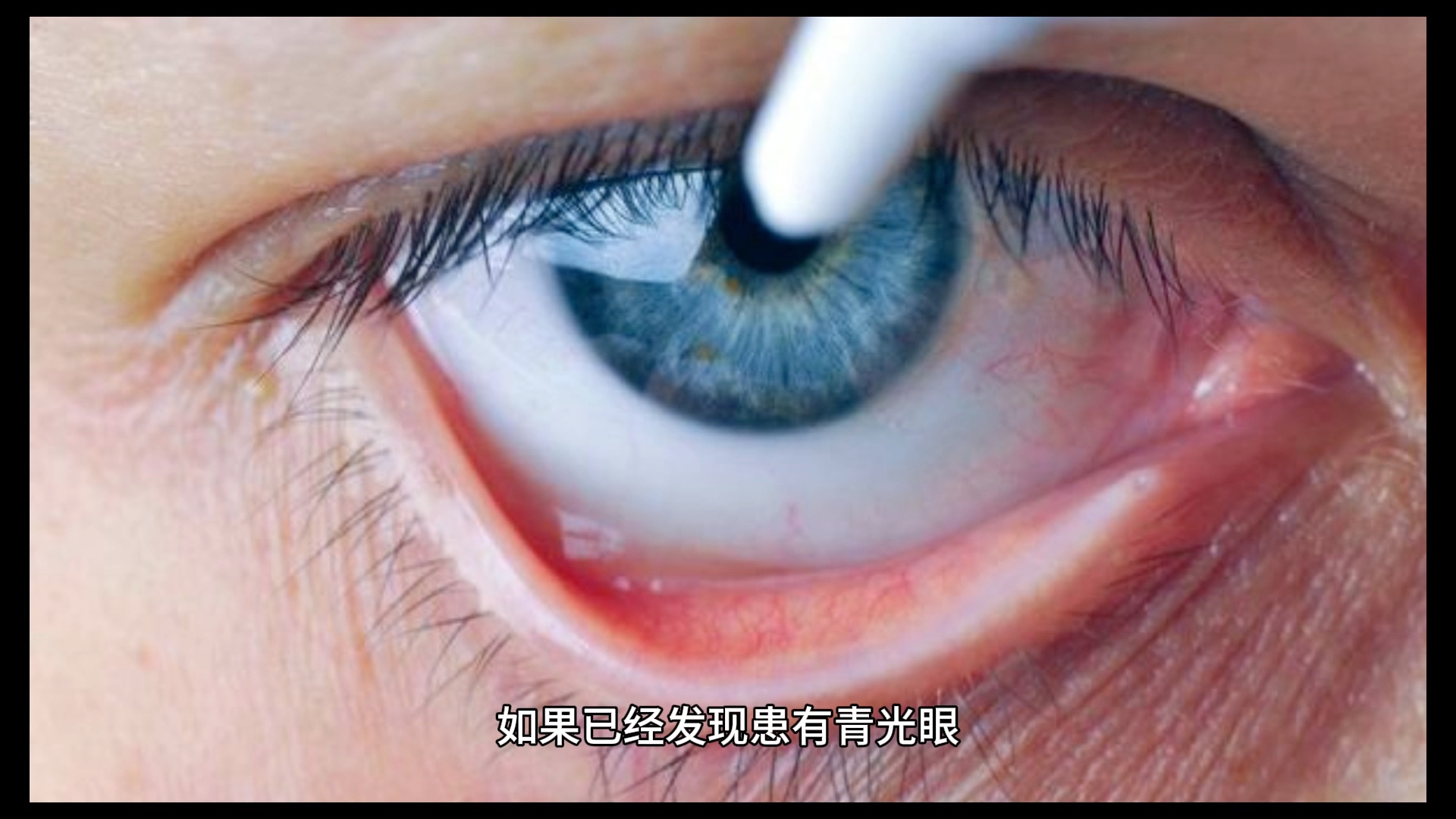 青光眼是怎么引起的（青光眼是如何出现的？医生：除了3点诱发因素，还要注意日常小事） | 说明书网