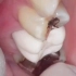 什么是临时牙？为什么要做临时牙