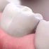 治疗牙齿敏感太简单，牙齿敏感的原因，3D演示。。