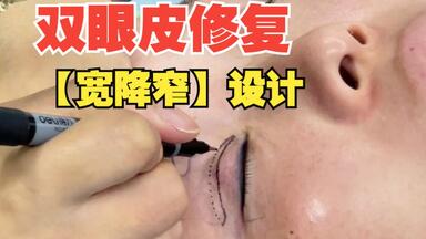 <em class="keyword">双眼皮修复</em>！宽降窄划线设计