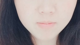 埋线是怎么样的 da801a467f19b5cc111eaf1d05647f26cff44ea1.jpg@280w_158h_1c_100q.jpg