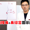 图示解析｜单纯隆鼻与鼻综合的效果变化