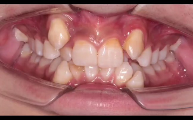 牙齿重度拥挤拔牙矫正，口腔卫生不佳