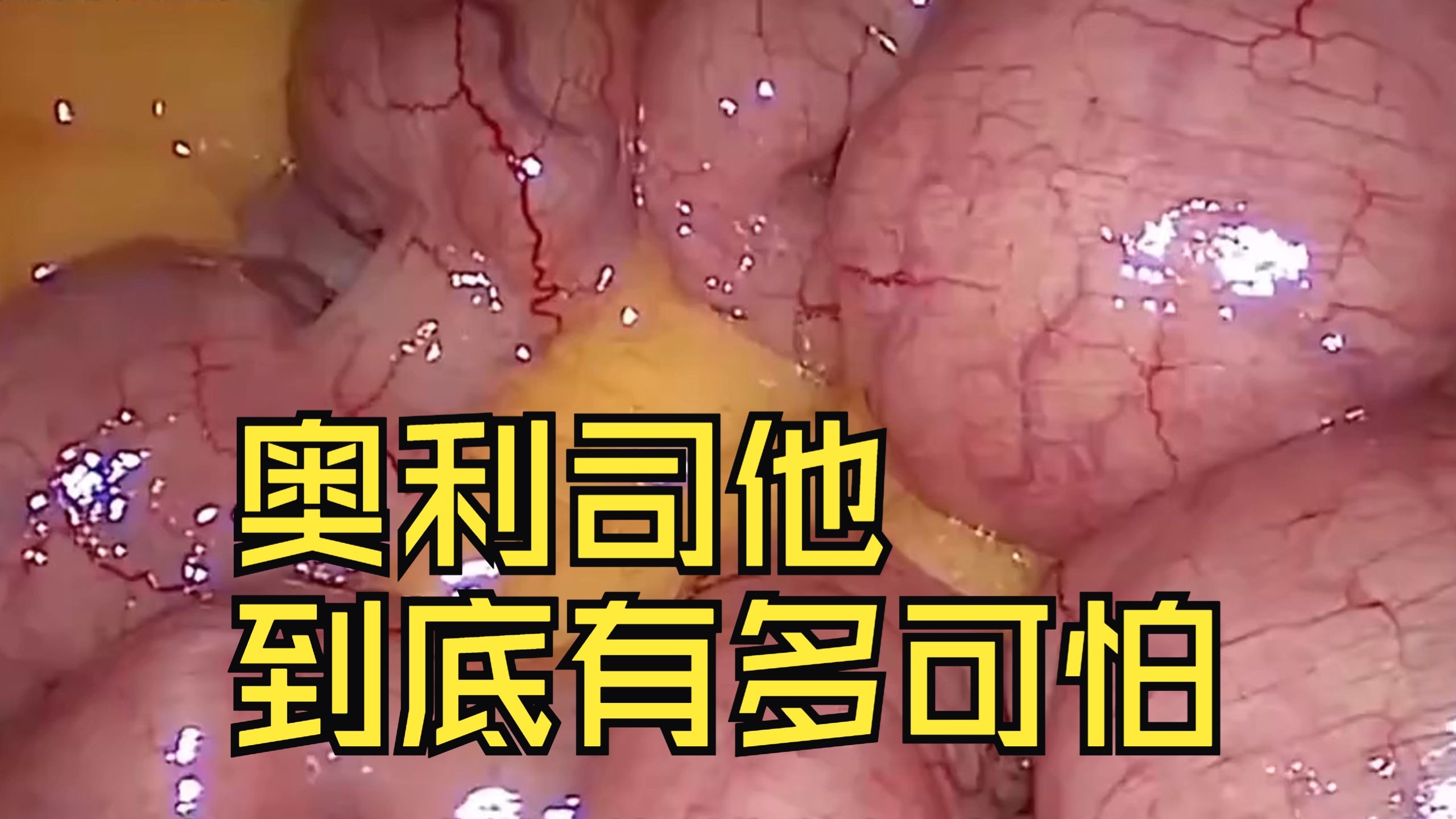 网传奥利司他，到底有多可怕？