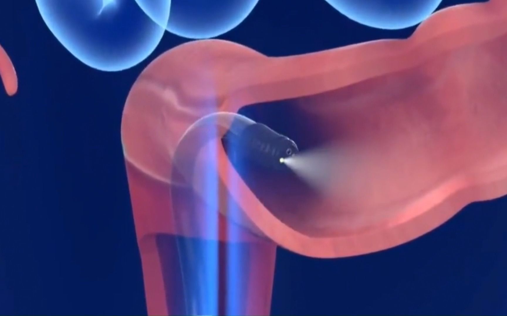 3D动画演示--肠镜过程