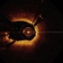 OCT血管内窥光学相干断成像系统-临床示例