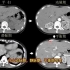 什么是CT增强扫描？如何区分动脉期、静脉期？放射科医生带你认识