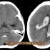 脑室、脑池、脑沟出血在CT上什么表现？分享几例典型病例