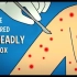 【Ted-ED】我们如何战胜致命的天花病毒 How We Conquered The Deadly Smallpox V