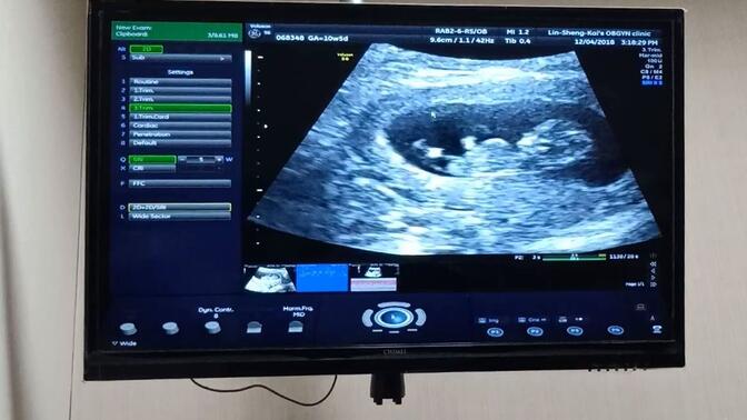 怀孕第10周第一次B超产检，可以很清楚的看到宝宝在挥动手脚！