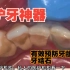 牙结石是如何产生的，预防大于治疗