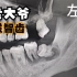 【智齿奇葩说】65岁老大爷智齿长期发炎，导致下牙槽神经岌岌可危