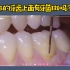【深圳洗牙】想知道你的牙齿上面是否有牙菌斑吗？