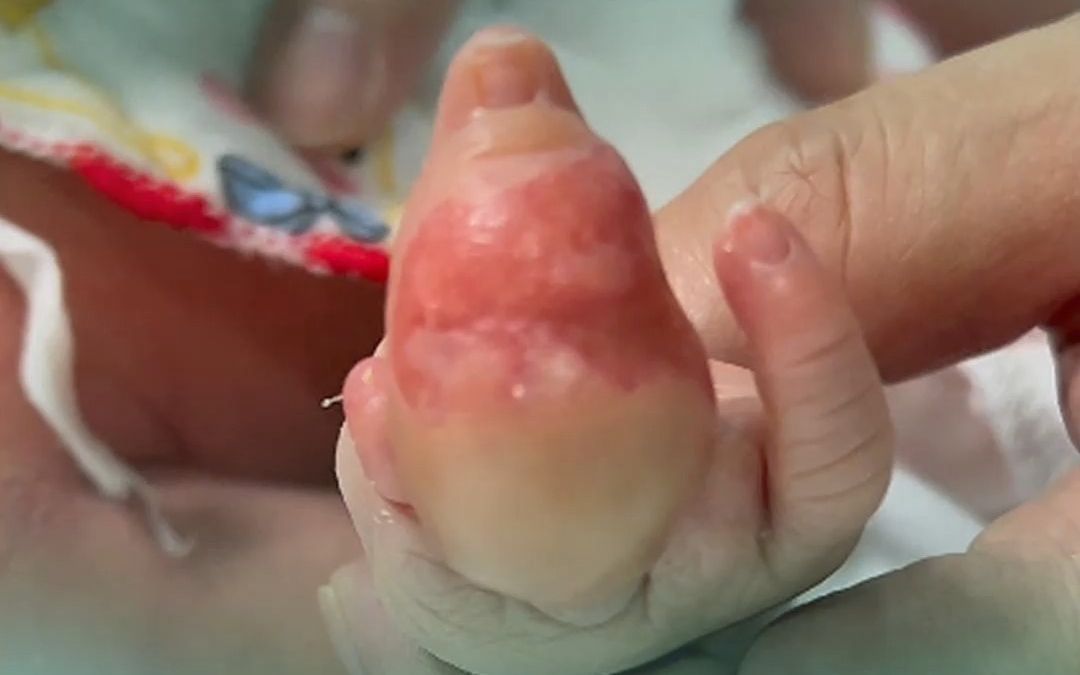 刚出生3天的宝宝，手指被束带紧紧勒住