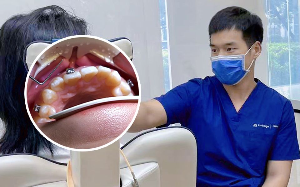 今天给患者戴个牙套，分享一下粘接全过程