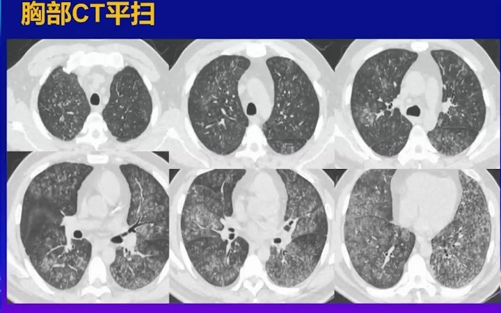 18.淋巴与间质性疾病思路影像诊断思维训练营系列3哔哩哔哩bilibili