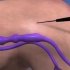 3D动画模拟静脉曲张微创治疗过程。