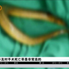 男子不小心将40厘米黄鳝塞入下体