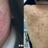 你以为长痘是普通现象？极有可能跟你的不健康生活有关