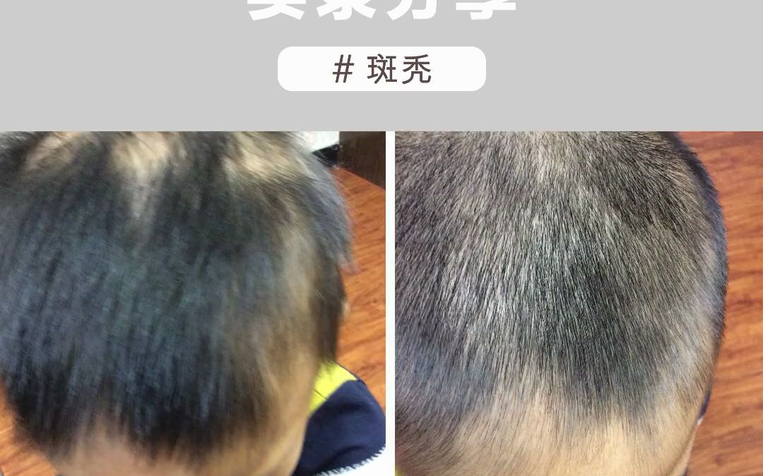 成都治疗脱发医院 成都治疗斑秃医院 成都中研皮肤病医院