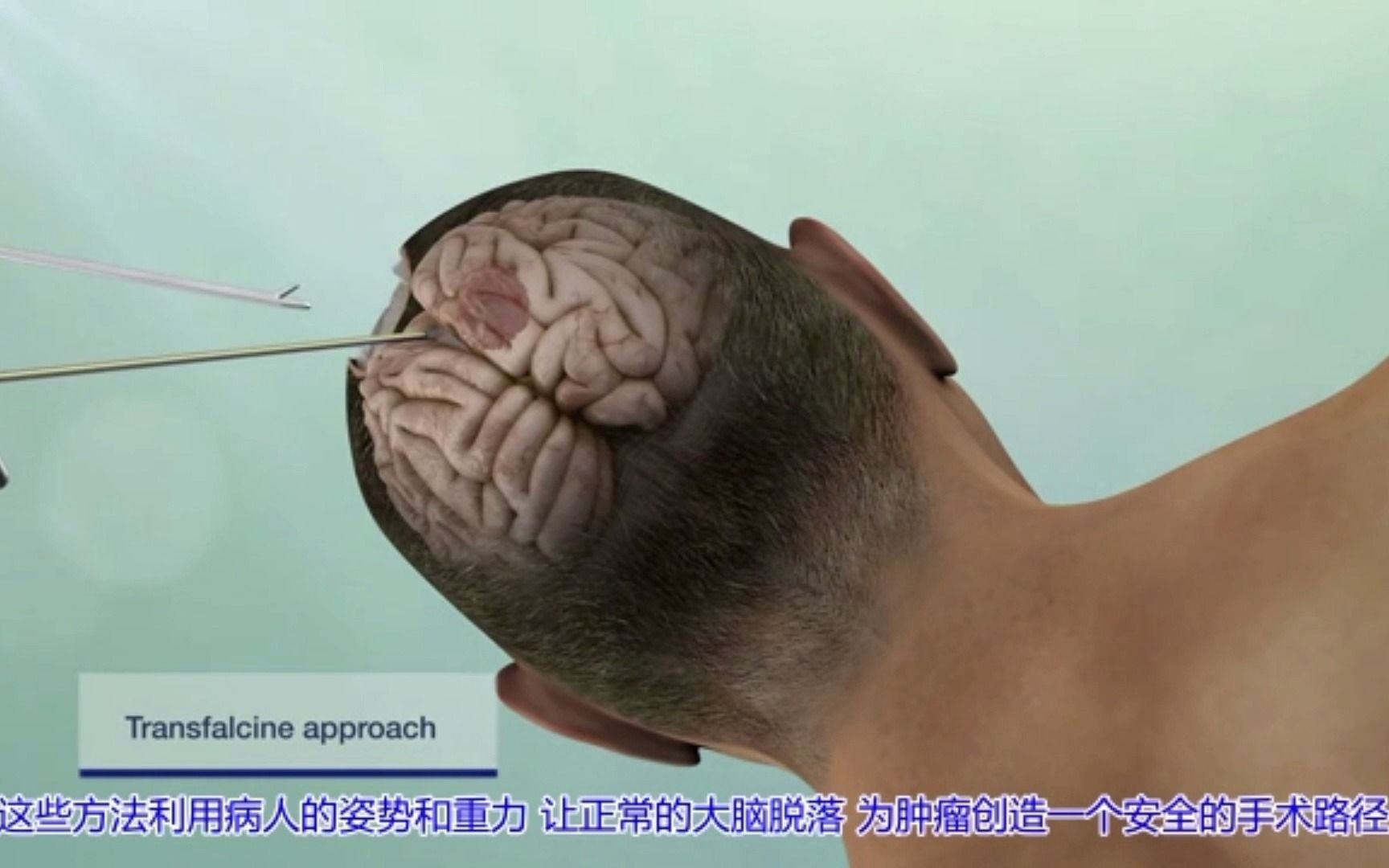 3D视频：在头上开一个锁孔大小的洞就可以去除脑肿瘤！