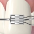 震撼超清！3D动画演示戴牙套的全过程！