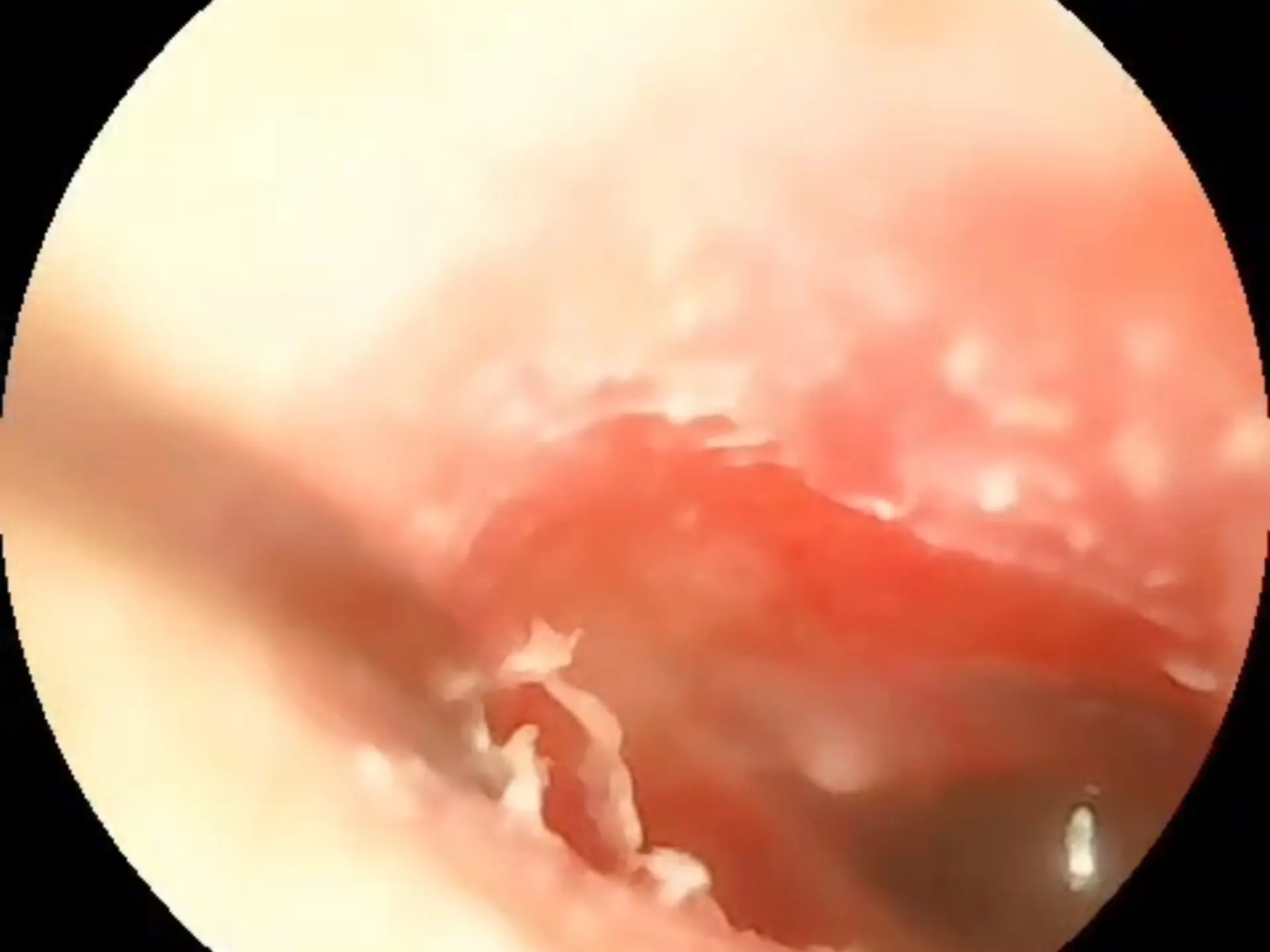 日常刮耳皮，突然整到一大块