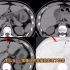36岁男性，剧烈腹痛，X光片未见明显异常，CT发现了什么？