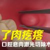 嘴里长了肉疙瘩？口腔息肉用激光30分钟处理