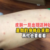 皮肤一旦出现这种状况，是你身体在求救，小红点“扎人”，扩散到脸上，徐医生巧解银屑病