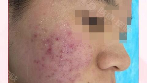 皮肤修复需要多少钱 ed5e4e18cd5bc7869cc54f9efe577e4525ebb154.jpg@480w_270h_1c