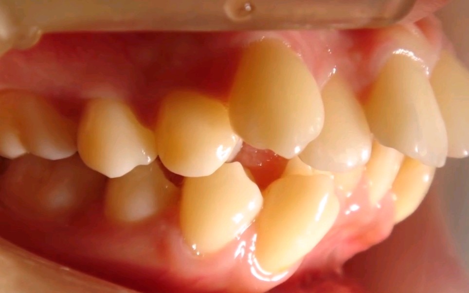 震撼！龅牙拔四颗牙24个月矫正的全过程记录！