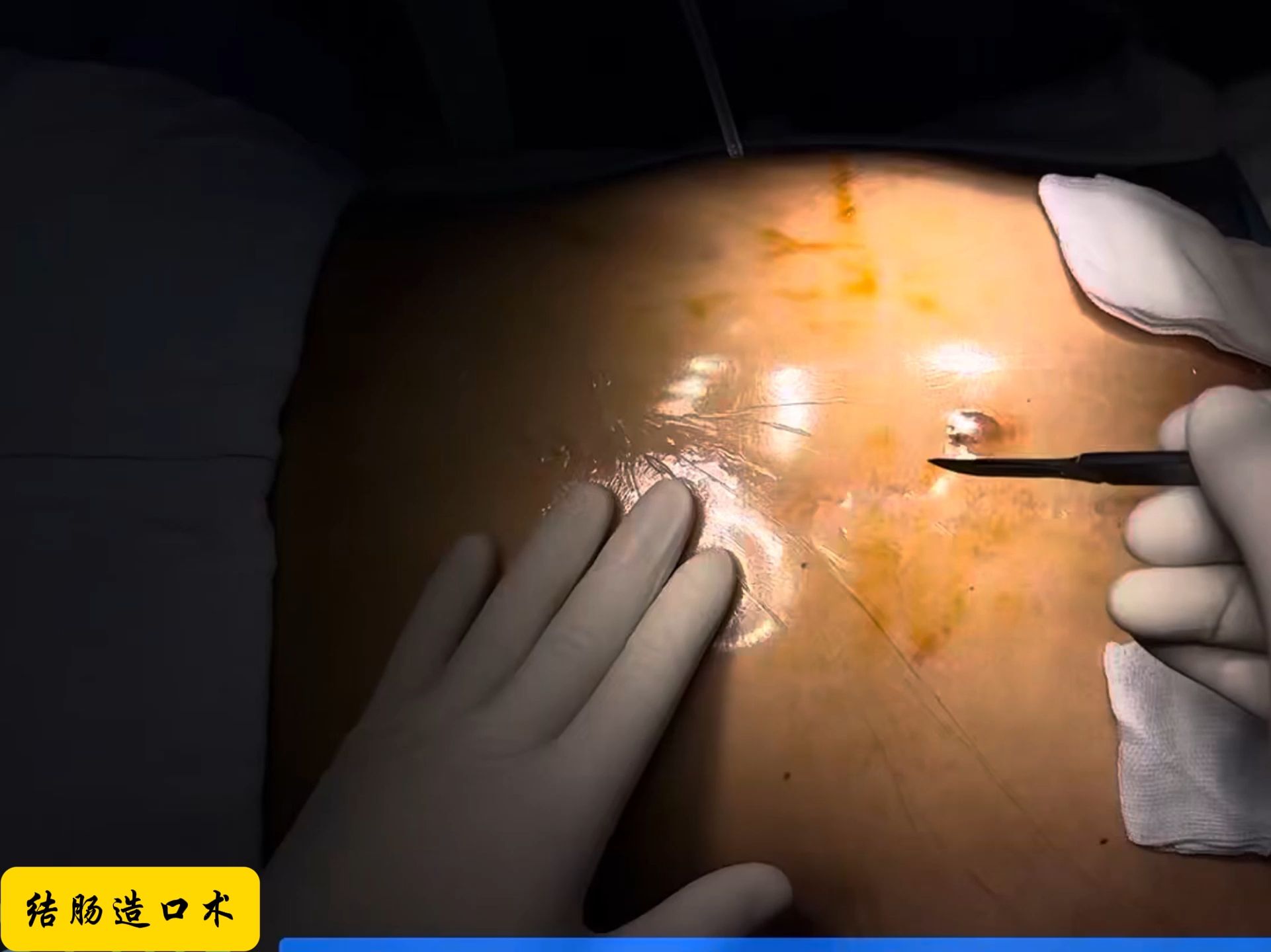 【手术】结肠造口术