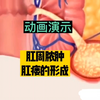 肛周脓肿，肛瘘的形成