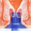 3D视频演示：痔疮手术