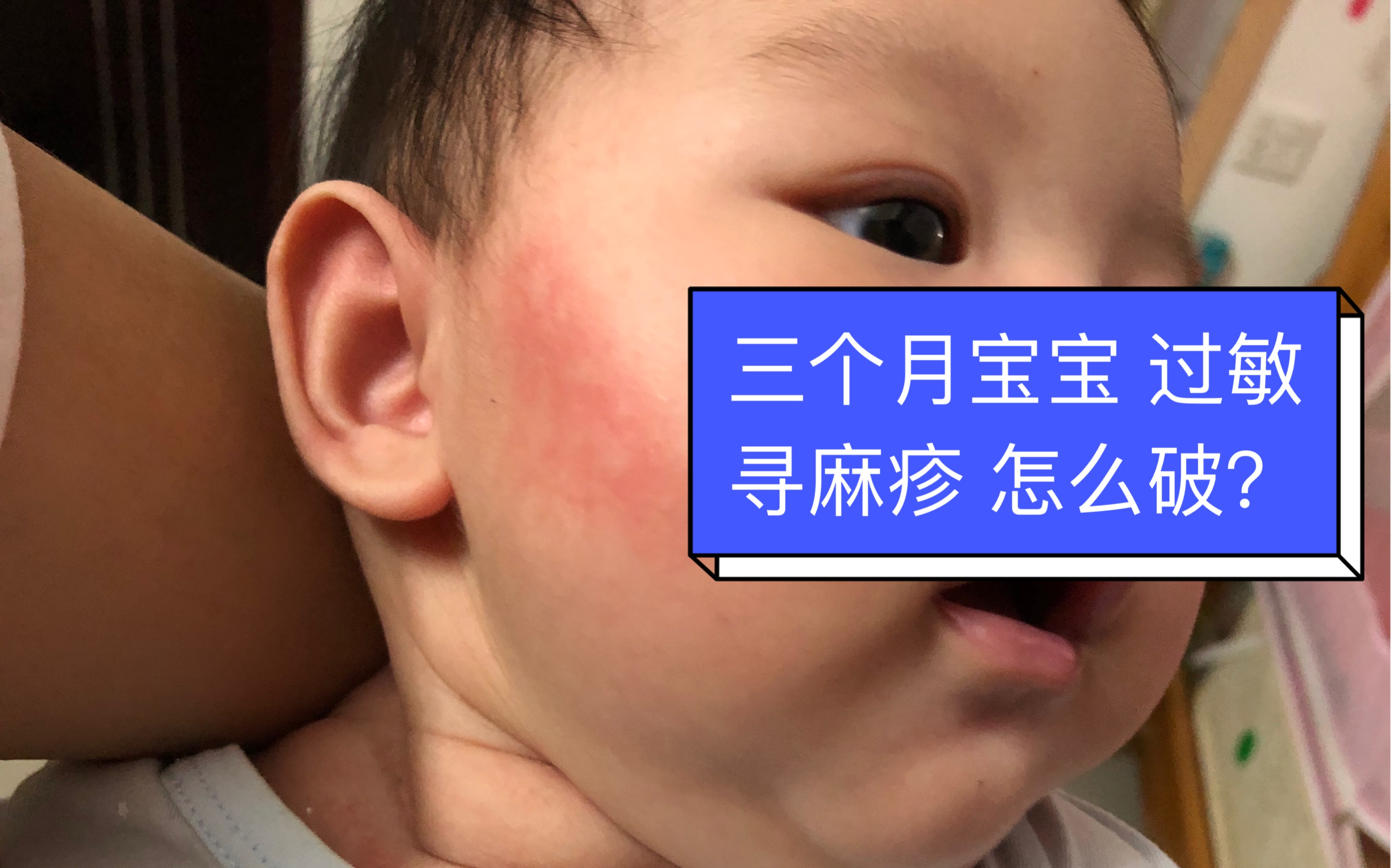 疹性荨麻疹-中国皮肤性病模型-医学