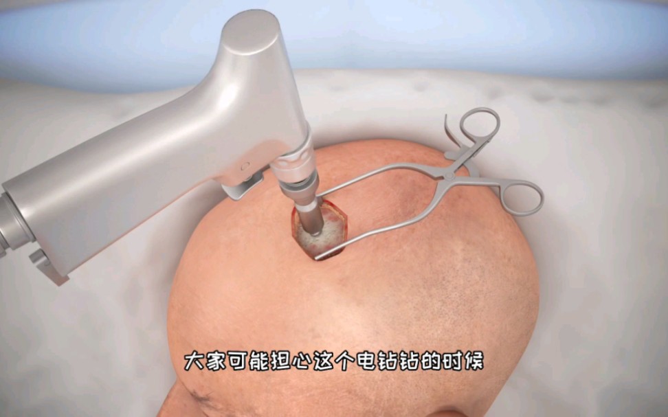 在脑袋上打洞，治疗脑出血手术过程，3D演示。。
