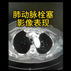 肺动脉栓塞影像表现CT读片要点