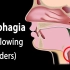 动画 | 吞咽障碍的常见成因