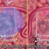 纳米刀-超短高压脉冲电场肿瘤消融技术
