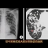 胸片和CT发现双肺多发实性结节，诊断什么？放射科医生讲解